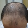 Бесшовная пересадка волос: особенности процедуры, показания и противопоказания