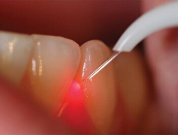 Лазерная имплантация – инновационный метод восстановления зубного ряда
